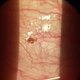 Imagen para el artículo titulado Acude al médico por una irritación en el ojo y le encuentran una garrapata en el globo ocular